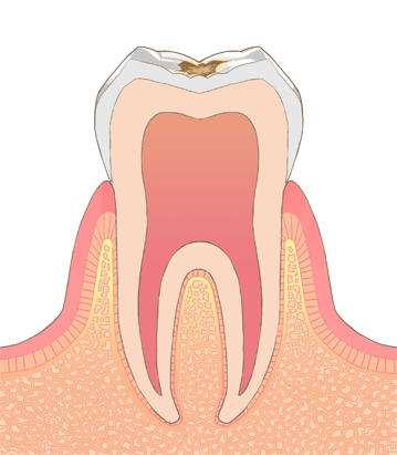 表面のエナメル質が侵された虫歯のイラスト