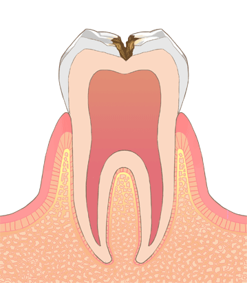 エナメル質の内部まで進行した虫歯のイラスト