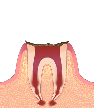 歯が溶け、歯根だけが残っている状態のイラスト