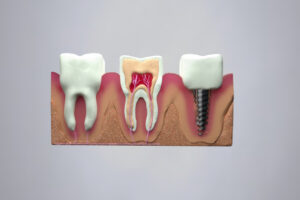 インプラントと歯の比較