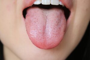 舌苔（ぜったい）の写真