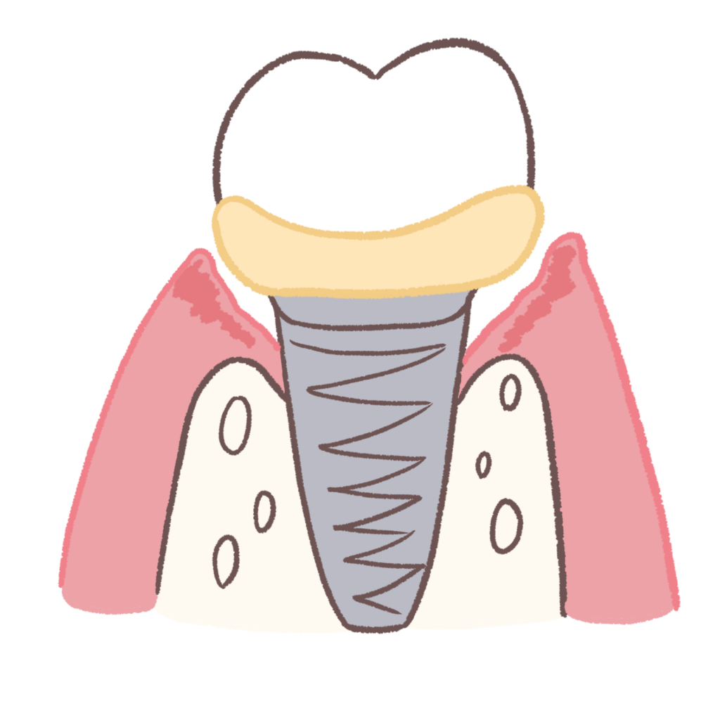 インプラント周囲炎のイラスト①