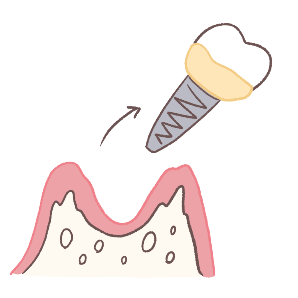 インプラント周囲炎のイラスト②