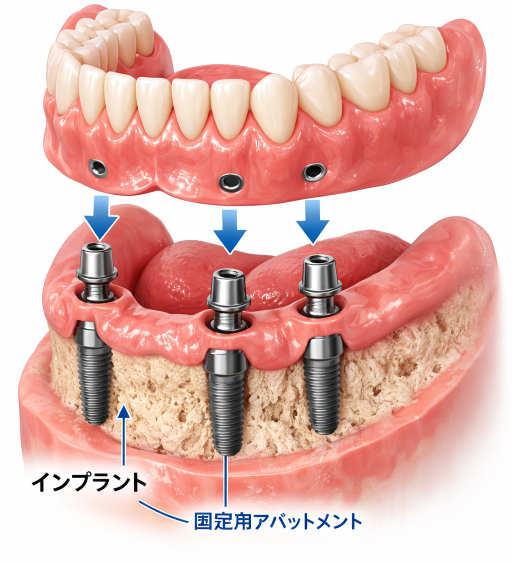 インプラント入れ歯の画像