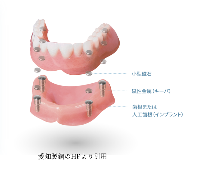 インプラントオーバーデンチャーの画像