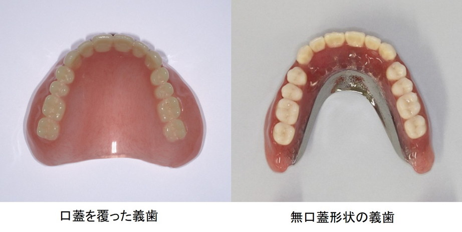 インプラントオーバーデンチャーを使用した入れ歯の画像