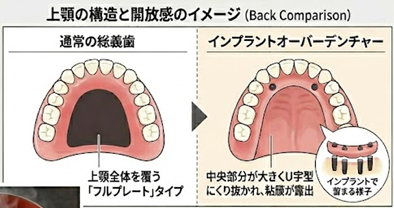 インプラントオーバーデンチャーのイラスト図解