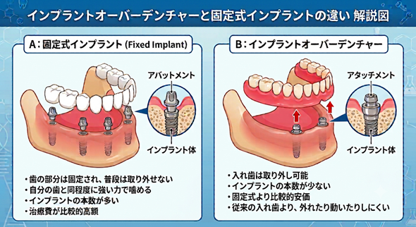 インプラントオーバーデンチャーと固定式インプラントの違い解説図