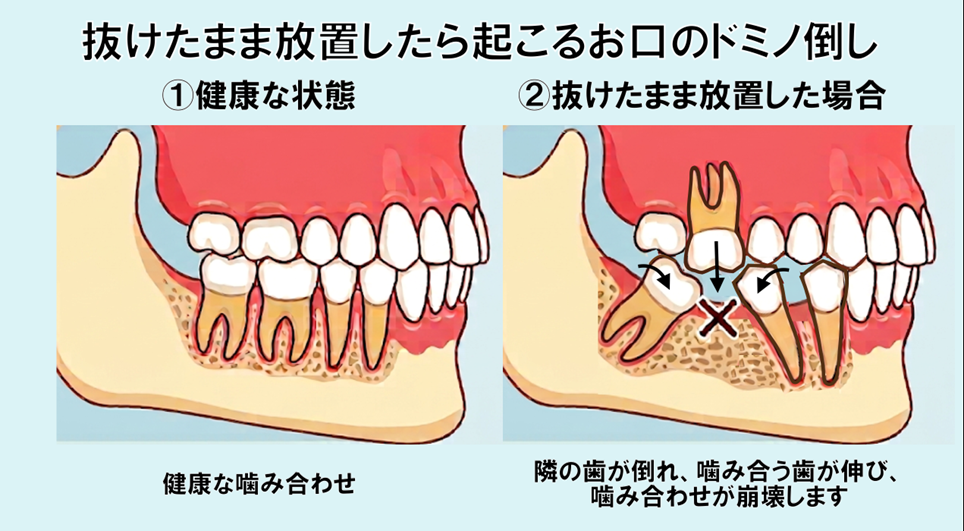 お口崩壊のドミノ倒しのイラスト