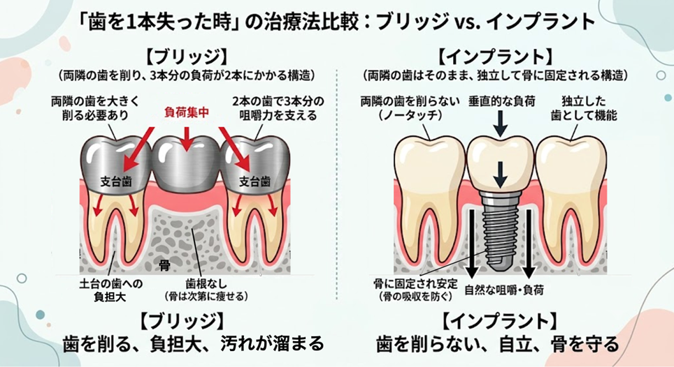 歯を1本失った時の治療法比較のイラスト